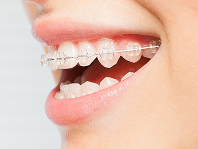 Inspirational Smiles Orthodontics | Children s Orthodontics, Two Phase Orthodontic Treatment and Interceptive Orthodontics